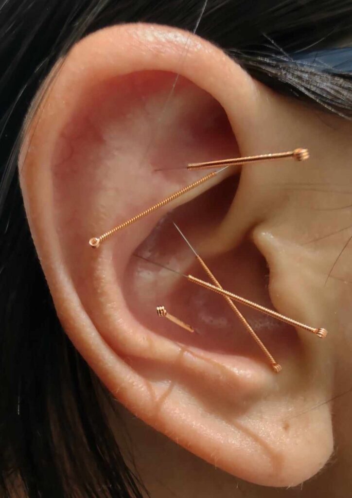 Approche Nada / Auriculothérapie, Acupuncture Sociale Sherbrooke