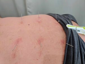 Acupuncture Sociale Sherbrooke, points dans le dos